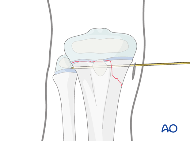 Closed reduction - Screw fixation for Epiphysiolysis with metaphyseal ...