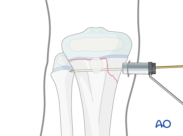 Inserting a soft-tissue protector for screw fixation of a Salter-Harris type-II fracture of the proximal tibia