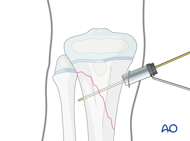 Insertion of a guide wire for screw fixation of a metaphyseal fracture of the proximal tibia