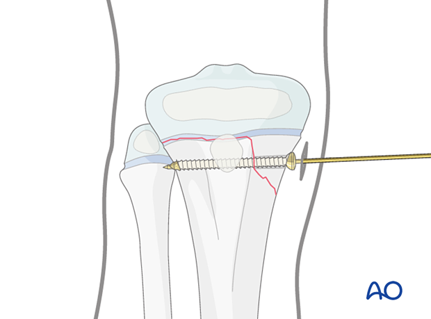 Screw fixation of a Salter-Harris type-II fracture of the proximal tibia