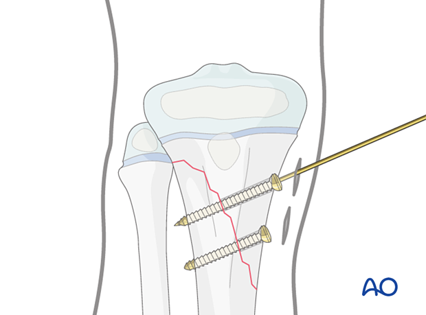 Screw fixation of a metaphyseal fracture of the proximal tibia