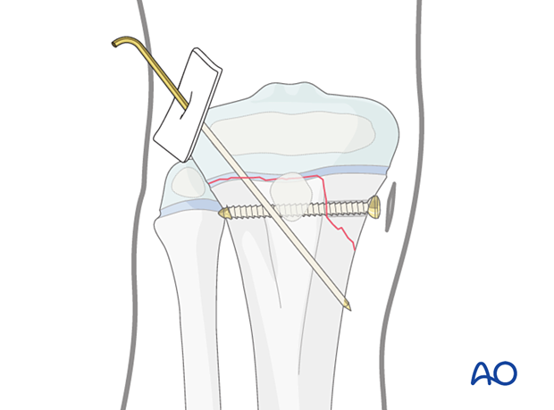 Screw fixation of a Salter-Harris type-II fracture of the proximal tibia with additional K-wire fixation