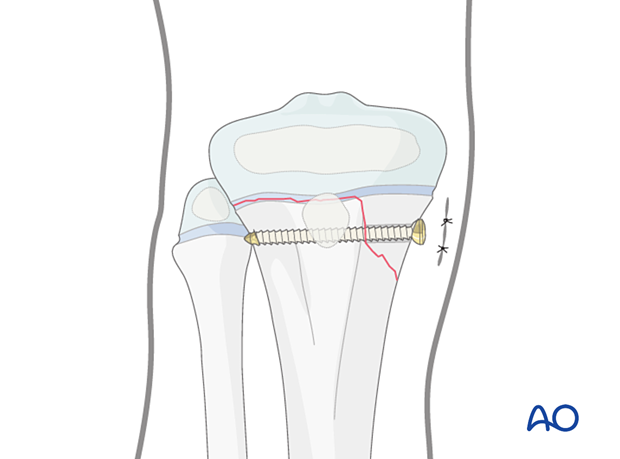 Screw fixation of a Salter-Harris type-II fracture of the proximal tibia