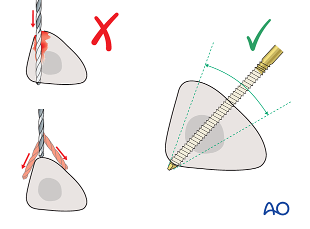 Drilling the tibia shaft