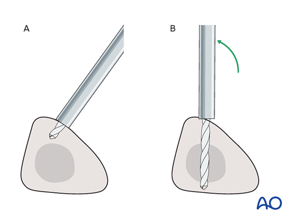 Drilling for anterior pin placement