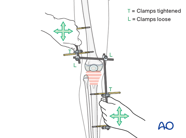 Reduction maneuver with the modular external fixator