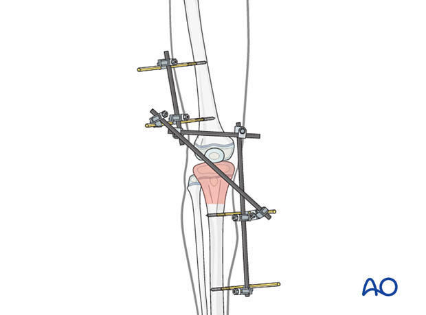 Joint-spanning external fixator with additional rod