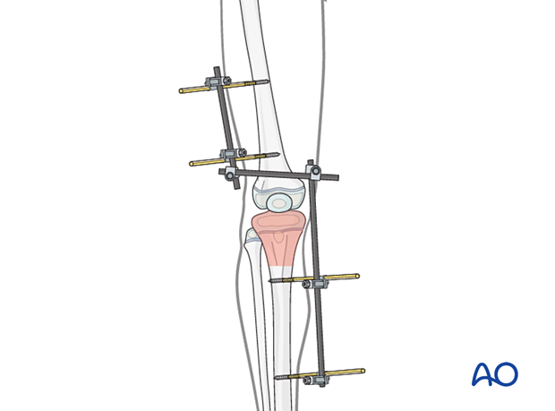 Joint-spanning external fixation