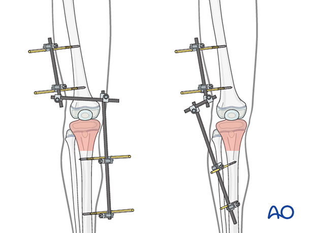 External fixator construct for temporary fixation