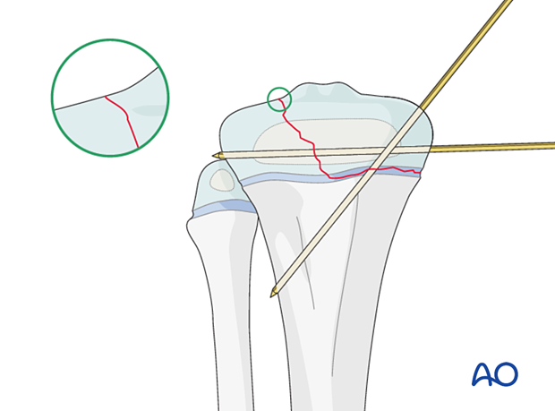 K-wire-wire fixation of a Salter-Harris type-III fracture of the proximal tibia