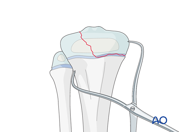 Direct reduction of a Salter-Harris type-III fracture of the proximal tibia