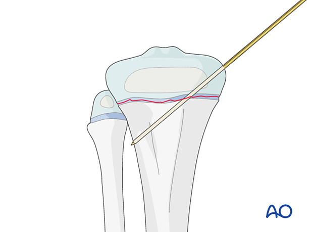 Insertion of first K-wire for fixation of a Salter-Harris type-I fracture of the proximal tibia