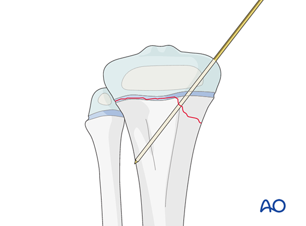 Incision for open reduction of entrapped periosteum in a Salter-Harris type-II fracture of the proximal tibia