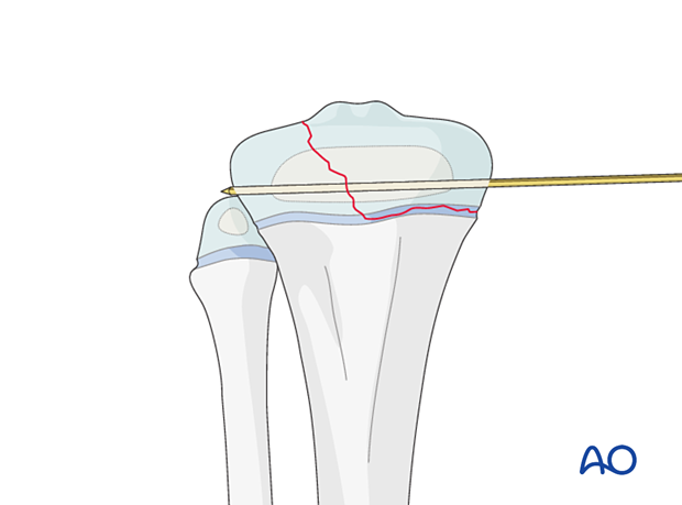 Insertion of the first K-wire for fixation of a Salter-Harris type-III fracture of the proximal tibia