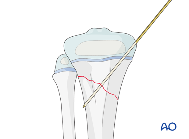 Insertion of first K-wire for fixation of a metaphyseal fracture of the proximal tibia