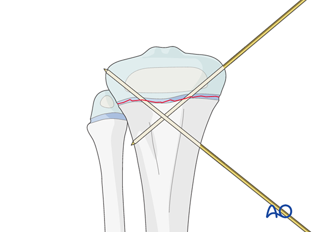 Insertion of second K-wire for fixation of a Salter-Harris type-I fracture of the proximal tibia