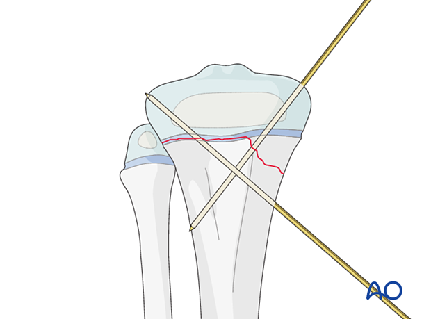 Insertion of second K-wire for fixation of a Salter-Harris type-II fracture of the proximal tibia