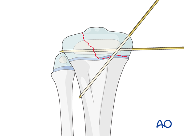 Insertion of second K-wire for fixation of a Salter-Harris type-III fracture of the proximal tibia