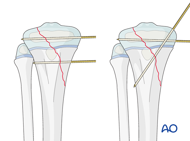 Insertion of K-wires for fixation of a Salter-Harris type-IV fracture of the proximal tibia