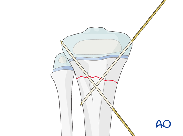 Insertion of second K-wire for fixation of a metaphyseal fracture of the proximal tibia