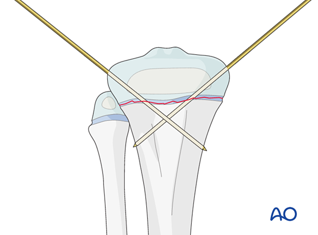 Insertion of second K-wire for fixation of a Salter-Harris type-I fracture of the proximal tibia