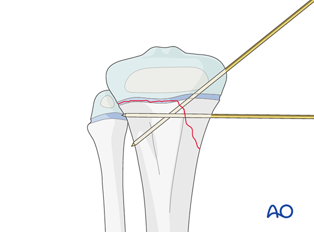 Insertion of second K-wire for fixation of a Salter-Harris type-II fracture of the proximal tibia