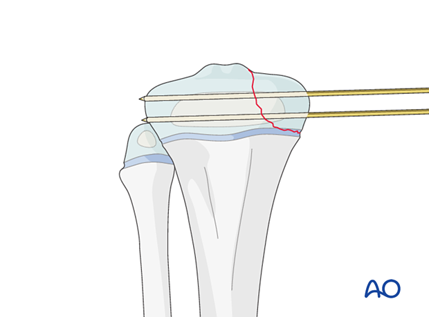 Insertion of second K-wire for fixation of a Salter-Harris type-III fracture of the proximal tibia