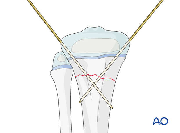 Insertion of second K-wire for fixation of a metaphyseal fracture of the proximal tibia