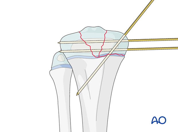 Insertion of K-wires for fixation of a multifragmentarySalter-Harris type-III fracture of the proximal tibia