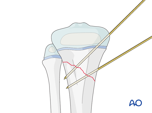 Insertion of second K-wire for fixation of a metaphyseal fracture of the proximal tibia