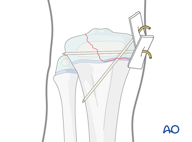 K-wire-wire fixation of a Salter-Harris type-III fracture of the proximal tibia