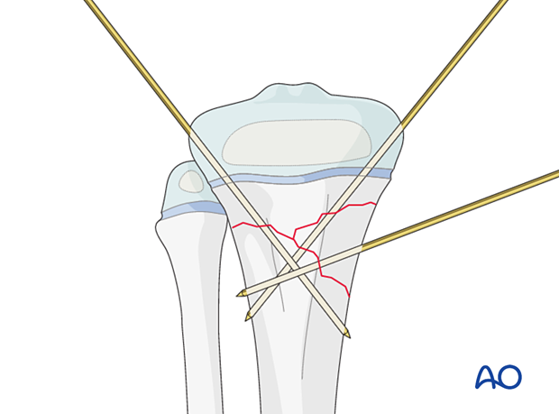 Insertion of K-wires for fixation of a multifragmentary metaphyseal fracture of the proximal tibia