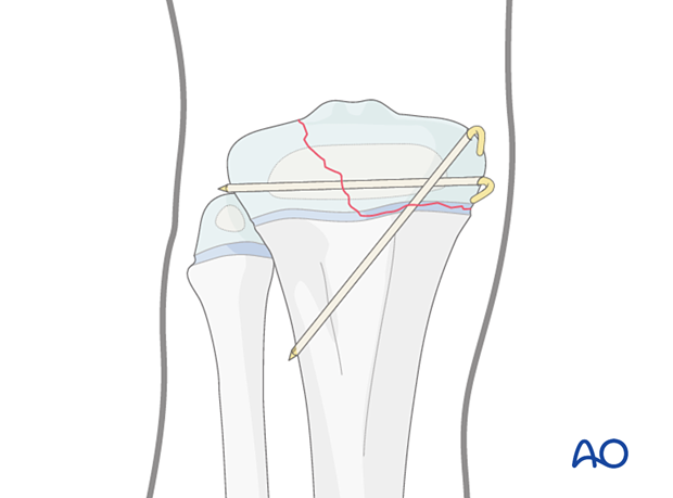 K-wire-wire fixation of a Salter-Harris type-III fracture of the proximal tibia