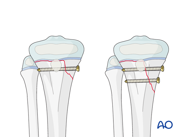 Screw fixation of a Salter-Harris type-II fracture of the proximal tibia