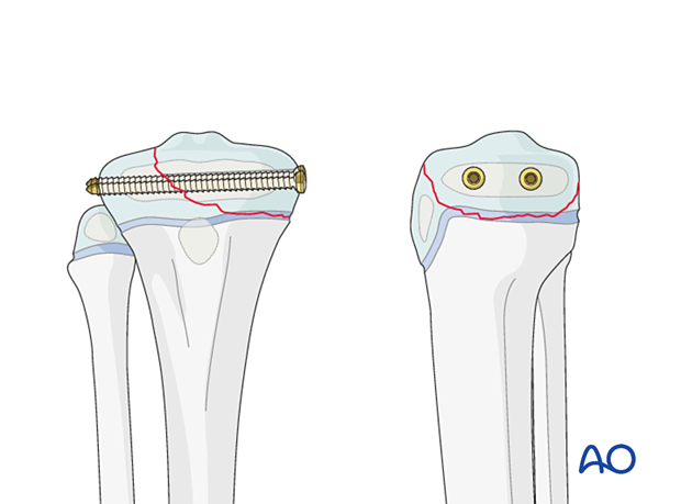 Screw fixation of a Salter-Harris type-III fracture of the proximal tibia