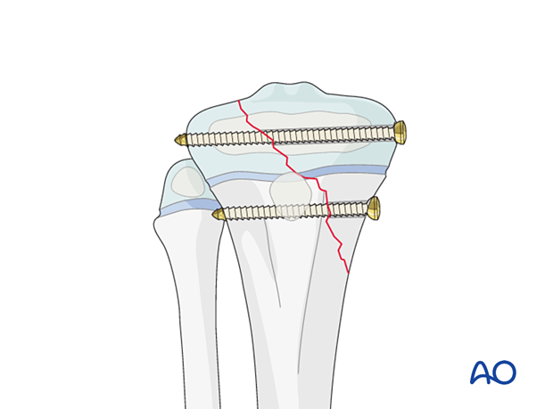 Screw fixation of a Salter-Harris type-IV fracture of the proximal tibia