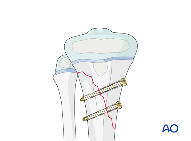 Screw fixation of a metaphyseal fracture of the proximal tibia