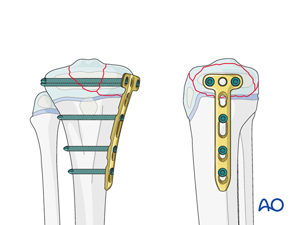 Screw and plate fixation of a Salter-Harris type-III fracture of the proximal tibia