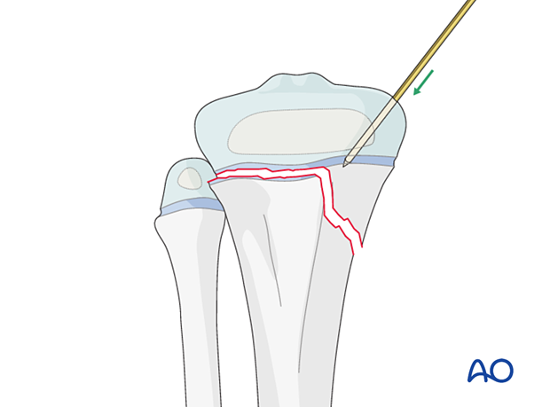 Reduction of a fragment of a Salter-Harris type-II fracture of the proximal tibia with a K-wire