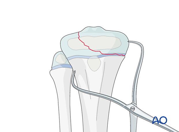 Open reduction of a Salter-Harris type-III fracture of the proximal tibia