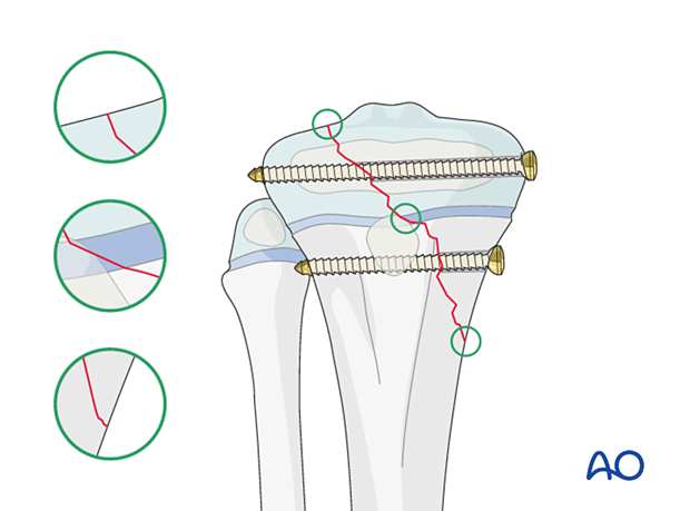 Screw fixation of a Salter-Harris type-IV fracture of the proximal tibia