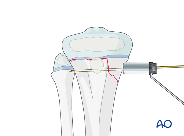 Inserting a soft-tissue protector for screw fixation of a Salter-Harris type-II fracture of the proximal tibia