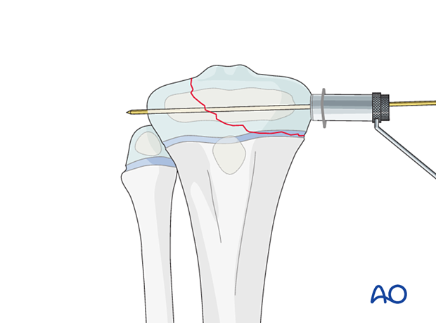 Inserting a soft-tissue protector for screw fixation of a Salter-Harris type-III fracture of the proximal tibia