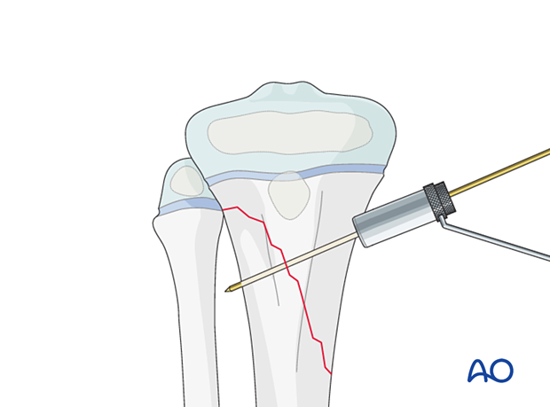 Insertion of a guide wire for screw fixation of a metaphyseal fracture of the proximal tibia