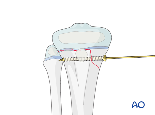 Screw fixation of a Salter-Harris type-II fracture of the proximal tibia