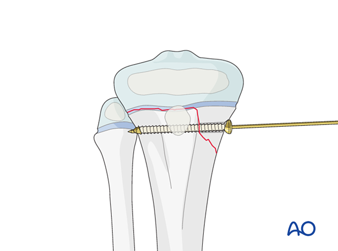 Reduction Screw Open reduction - Screw fixation for Epiphysiolysis with metaphyseal ...