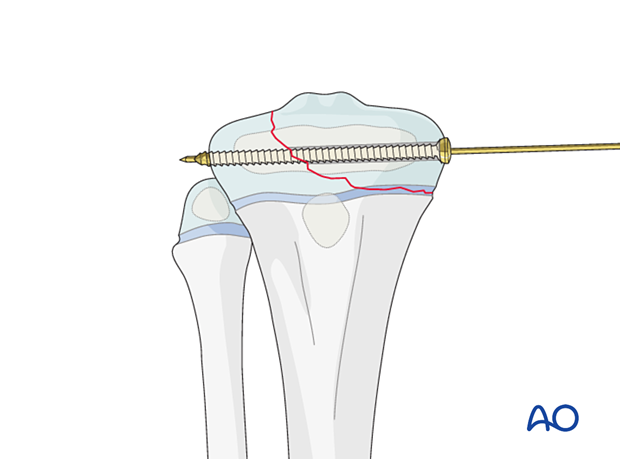 Screw fixation of a Salter-Harris type-III fracture of the proximal tibia