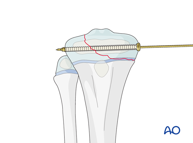 Reduction Screw Open reduction - Screw fixation for Epiphyseal and epi-metaphyseal ...