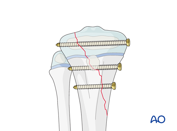 Screw fixation of a Salter-Harris type-IV fracture of the proximal tibia