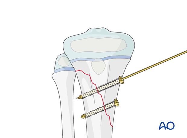 Screw fixation of a metaphyseal fracture of the proximal tibia